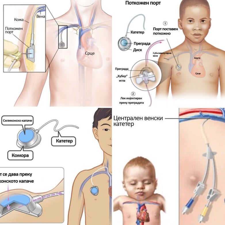 detska kardiohirurgija operacija